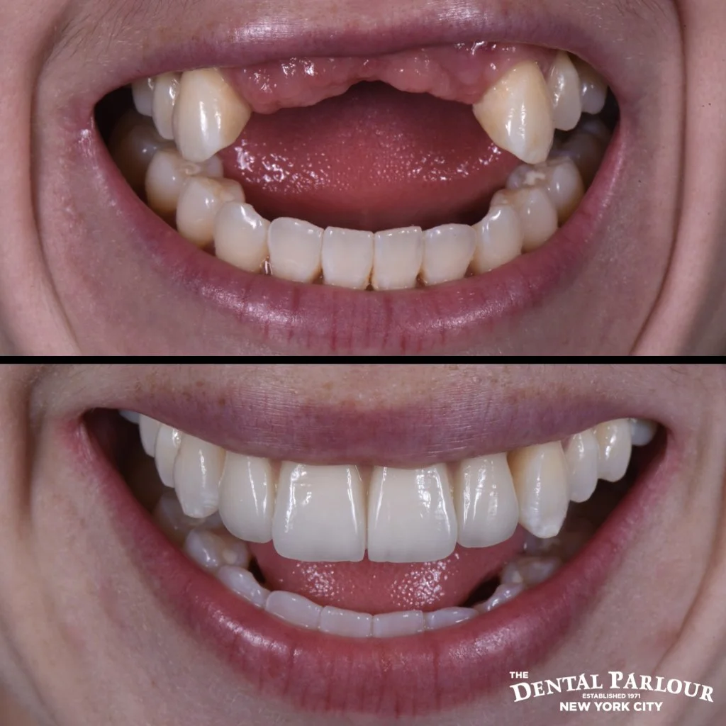 Complete smile makeover showing before and after results of extensive restorative dentistry.