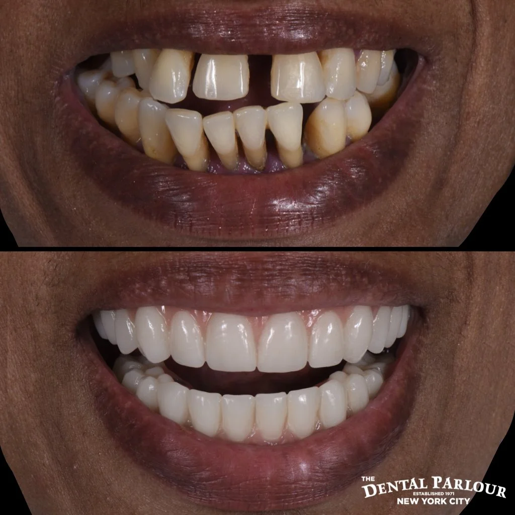 Before and after porcelain veneers for a patient with stained teeth and uneven smile.