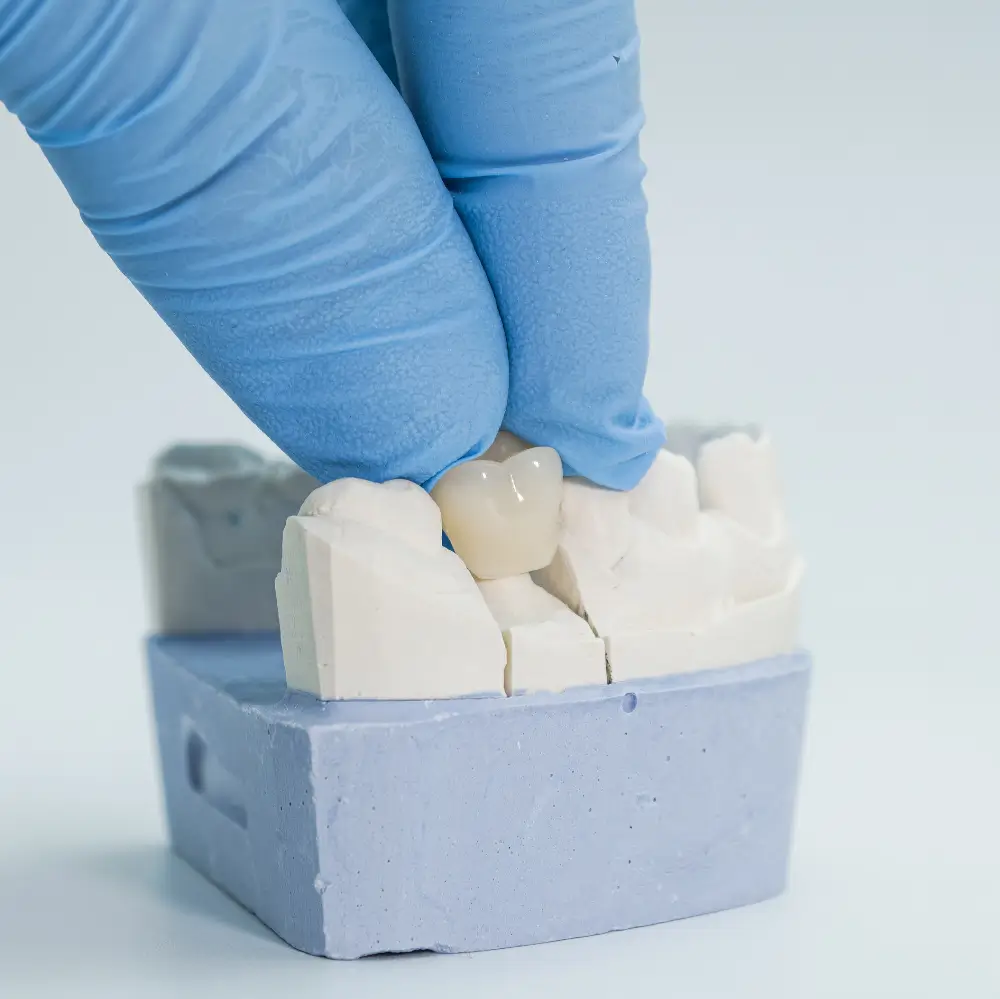 Dental technician fitting a custom dental crown onto a stone model of a patient's jaw.