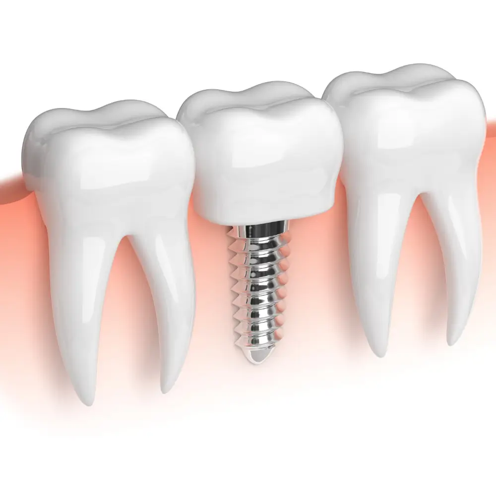 Anatomical illustration of a single dental implant and crown between natural teeth.
