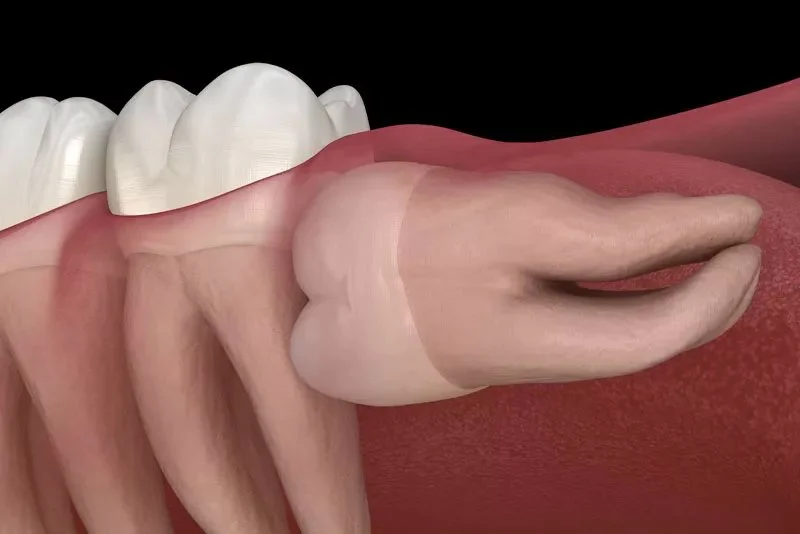 3D model showing a horizontal impacted wisdom tooth pushing against a molar.