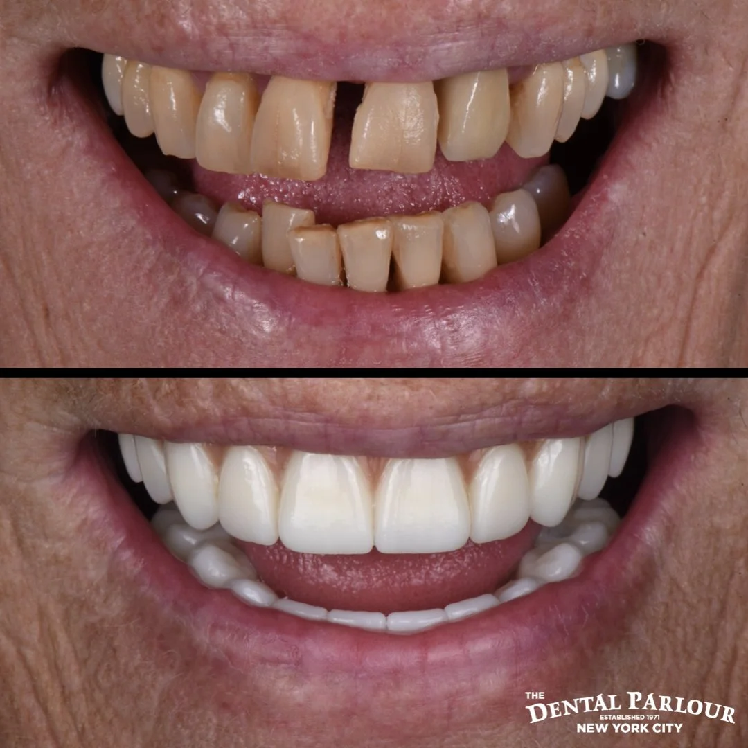 Before and after results of full mouth dental implants for a restored smile.