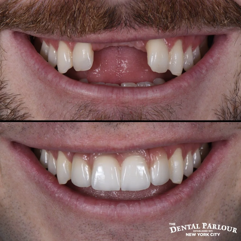 Before and after dental implants for a patient with multiple missing upper teeth.