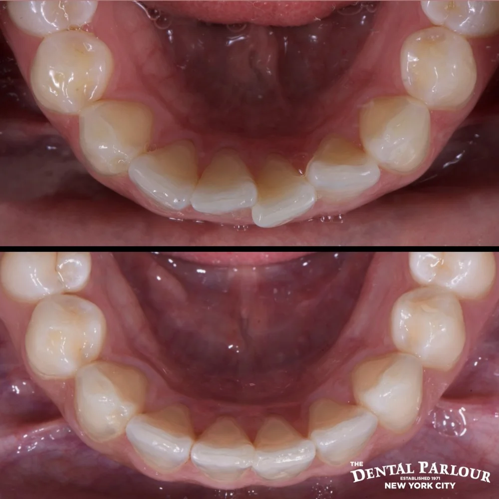 Before and after top-down view of dental arch alignment using Invisalign.