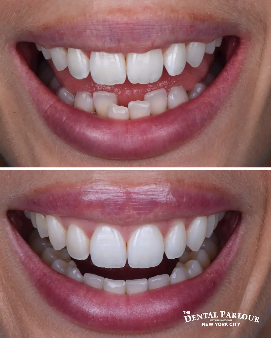 Invisalign before and after results showing teeth straightening without metal braces.