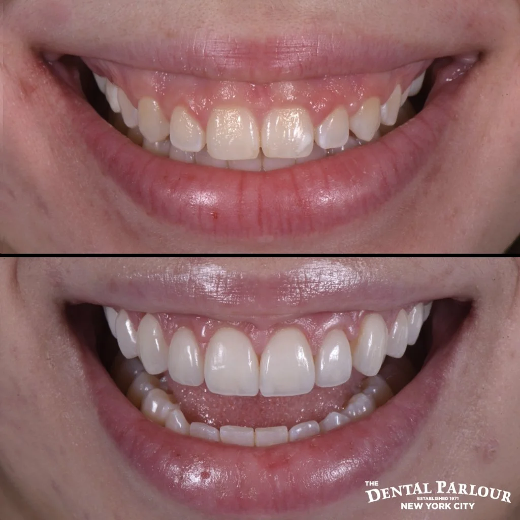 Patient smile transformation before and after cosmetic dentistry for a symmetrical look.