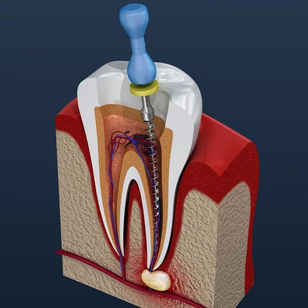 Medical diagram showing the steps of a root canal procedure to save a damaged tooth.