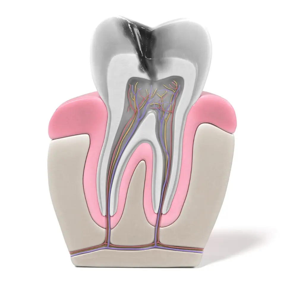 Cross-section illustration of a tooth undergoing a professional root canal treatment.