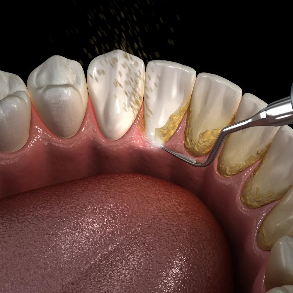 Dental hygienist using a scaler tool to remove tartar and plaque during a teeth cleaning.