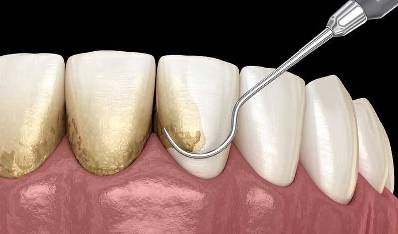 3D illustration of professional dental scaling to remove plaque and tartar from teeth.