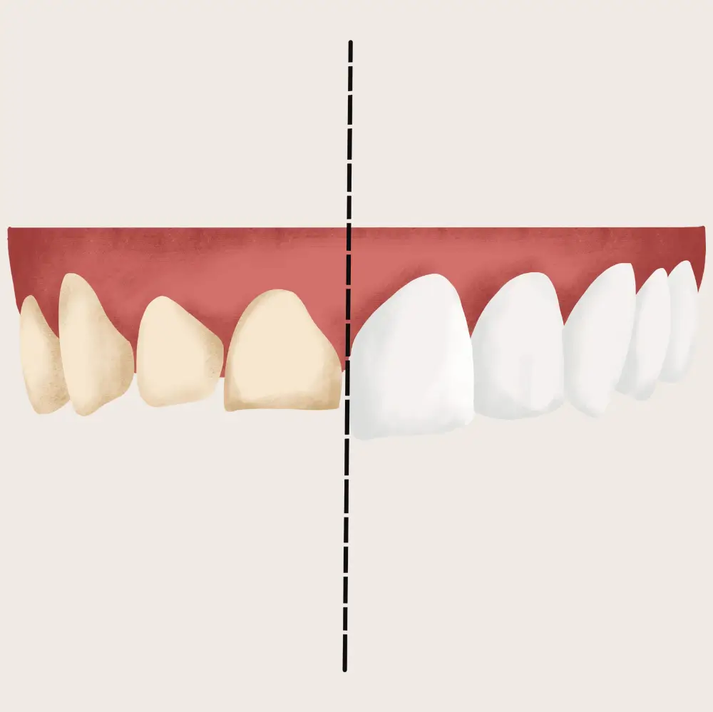 Comparison split-view showing yellow teeth vs. professionally whitened white teeth.