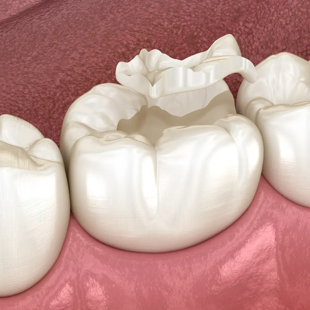 Close up of a molar with a natural-looking composite tooth-colored filling.