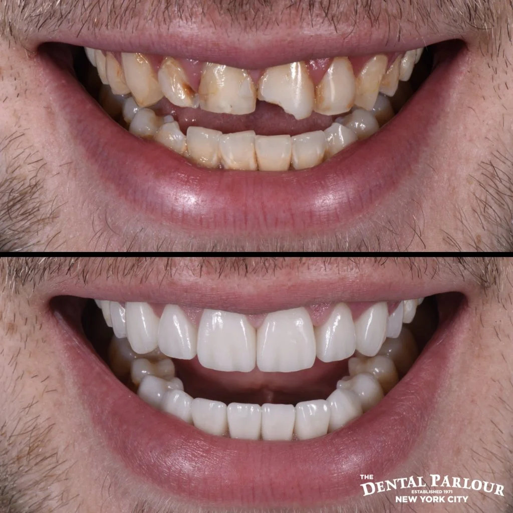 Significant smile improvement using dental veneers to correct deep tooth staining and chips.