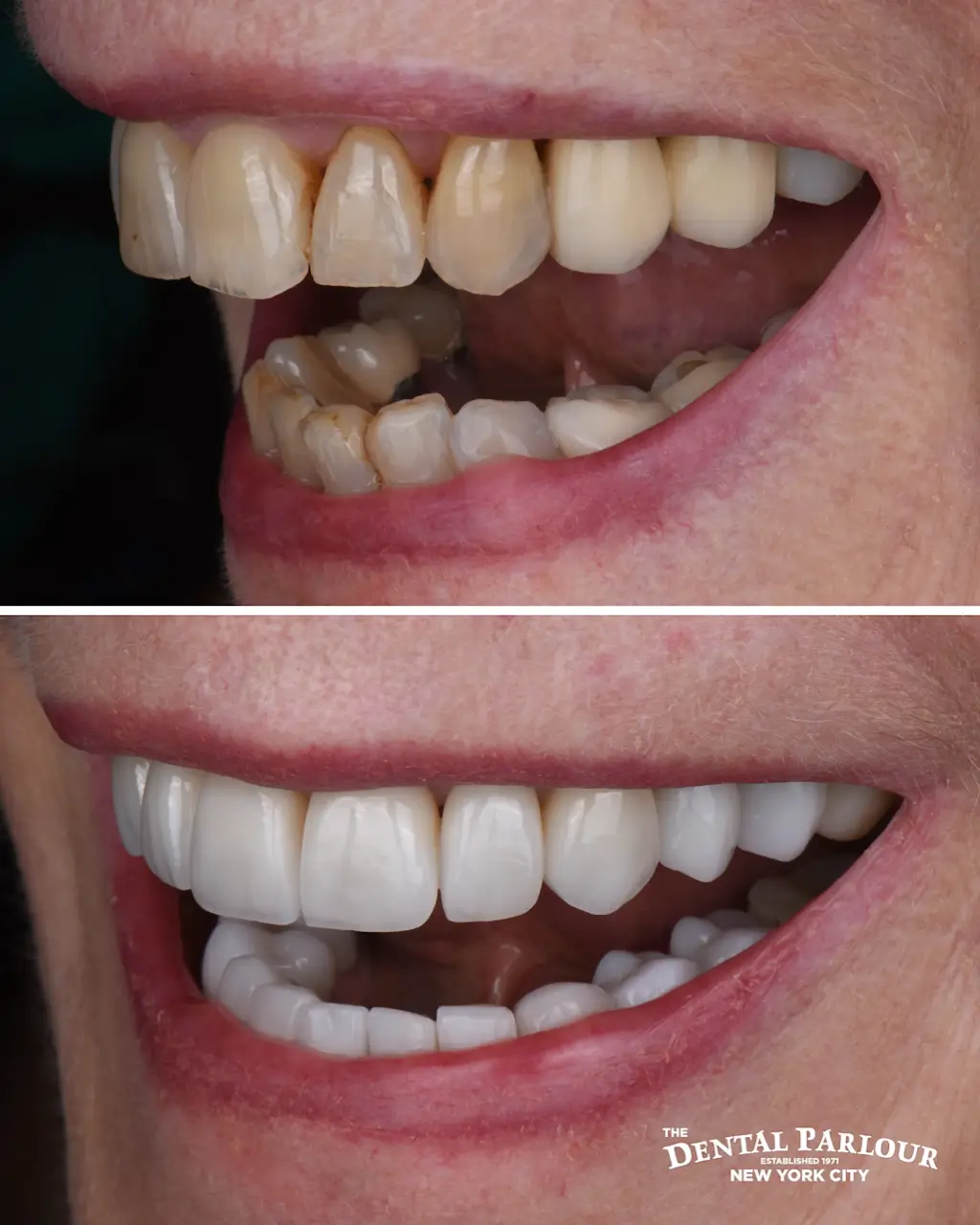 Smile correction before and after using dental veneers to fix chipped and stained teeth.