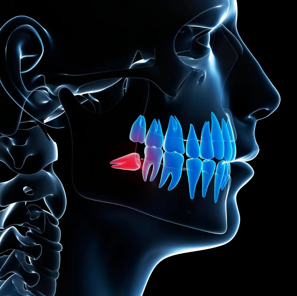 X-ray style illustration showing wisdom tooth pain and inflammation in the jaw.