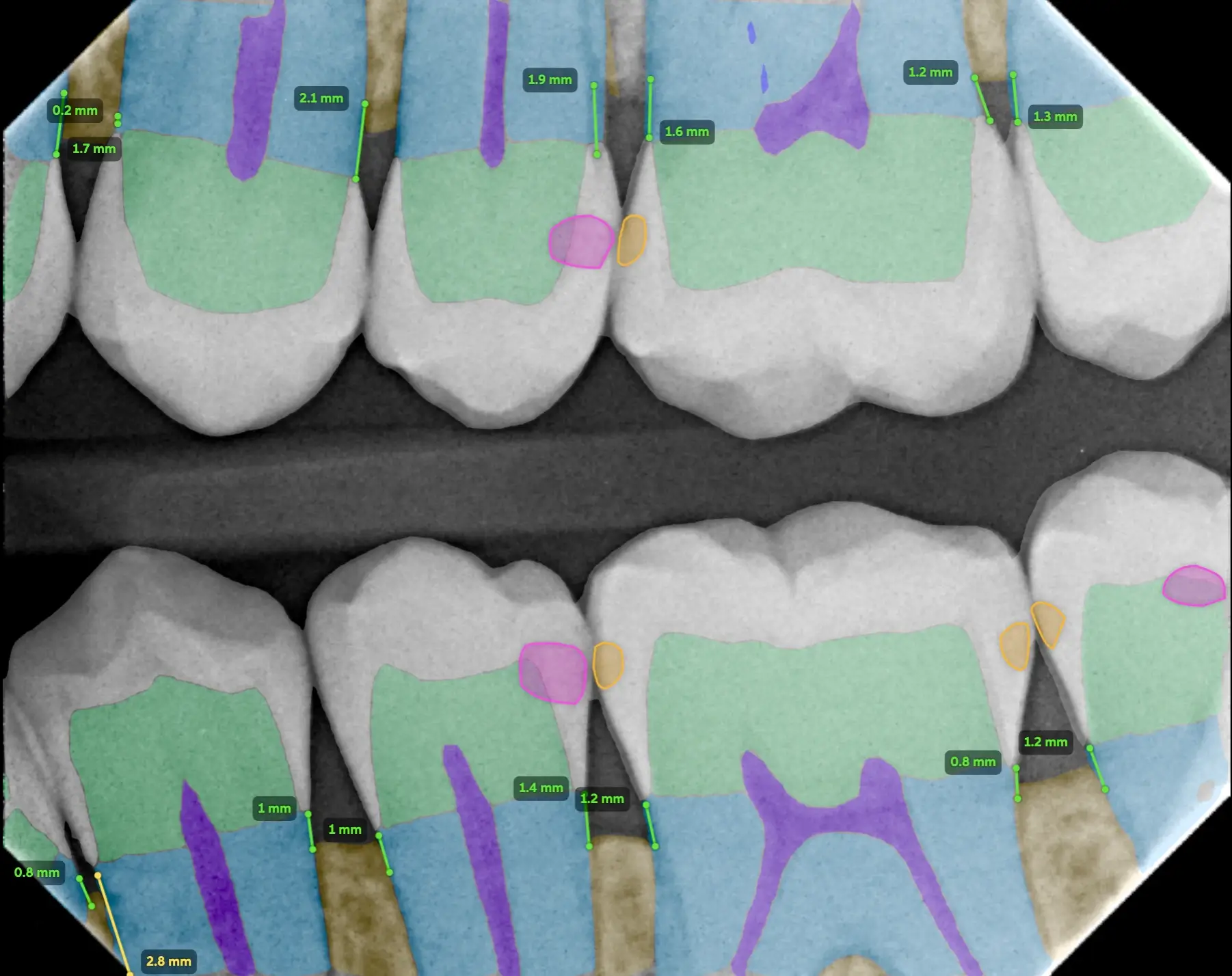 Digital scan of a row of teeth showing automated dental AI analysis results.