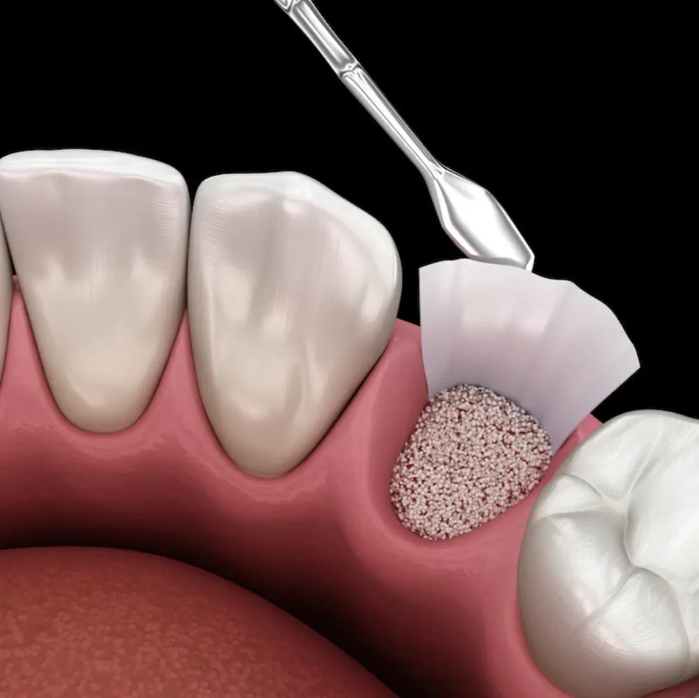 Illustration of a dental bone grafting procedure to strengthen the jawbone.