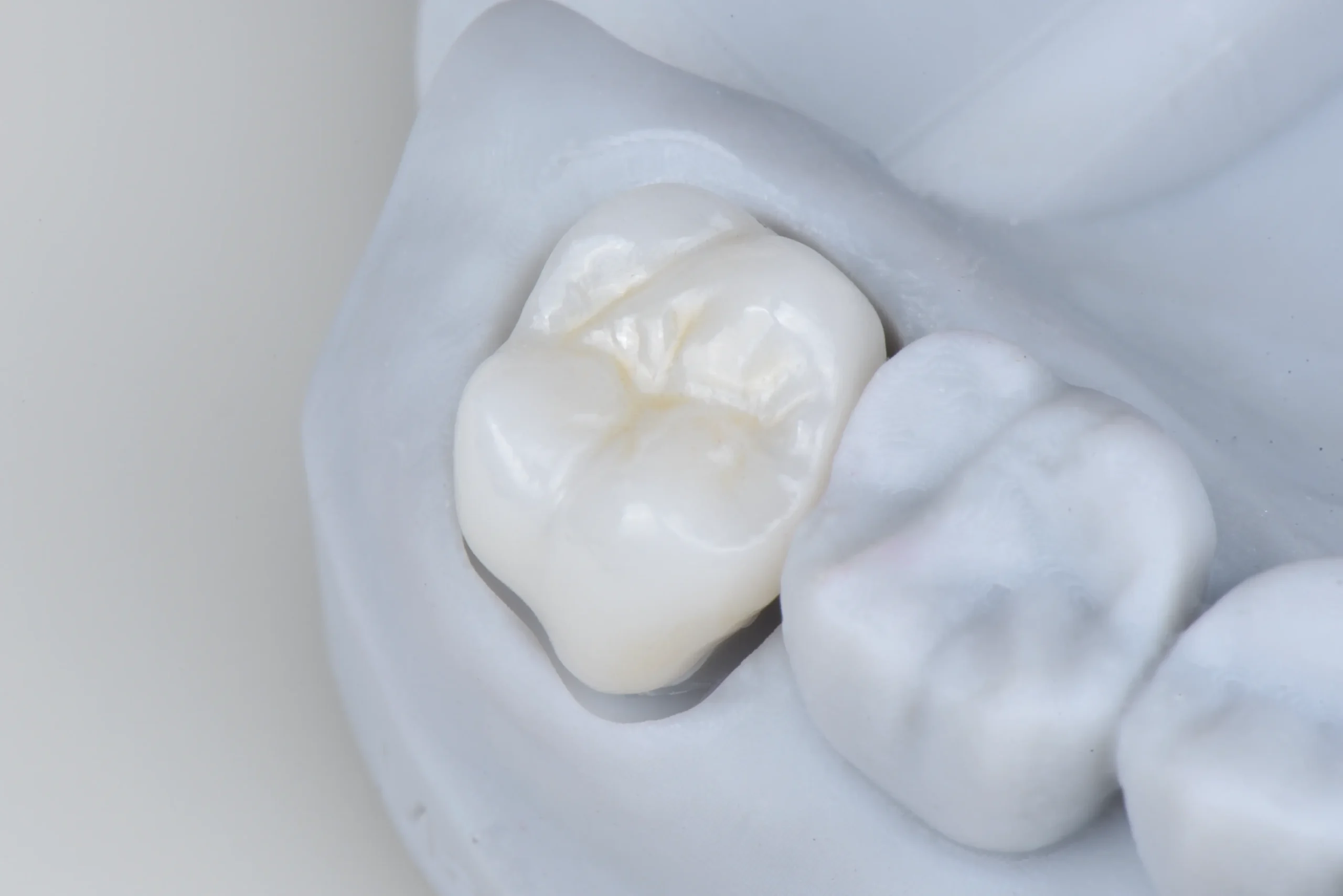 Close-up of a high-quality porcelain dental crown restoration