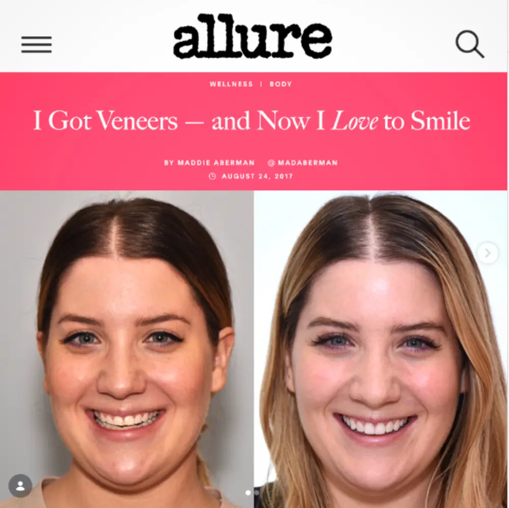 Allure Magazine feature showing dental veneer before and after results