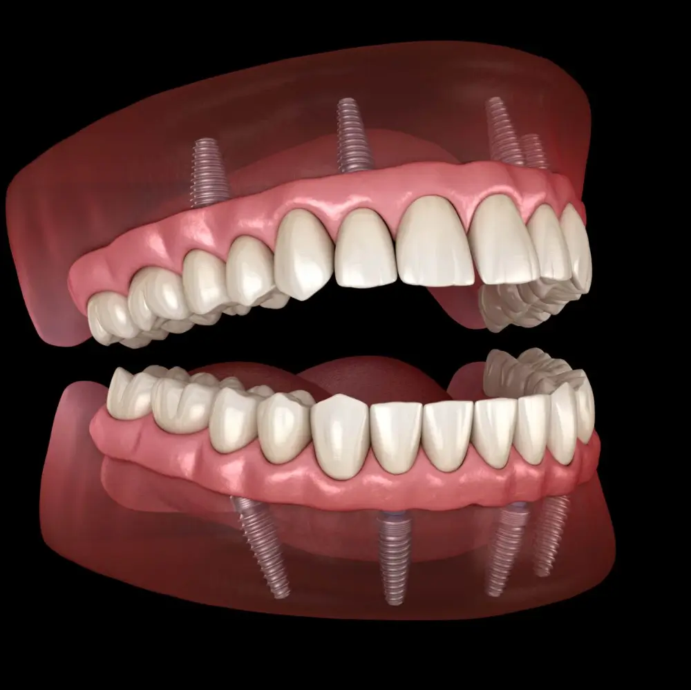 Digital illustration of full mouth dental implants on a lower jaw.