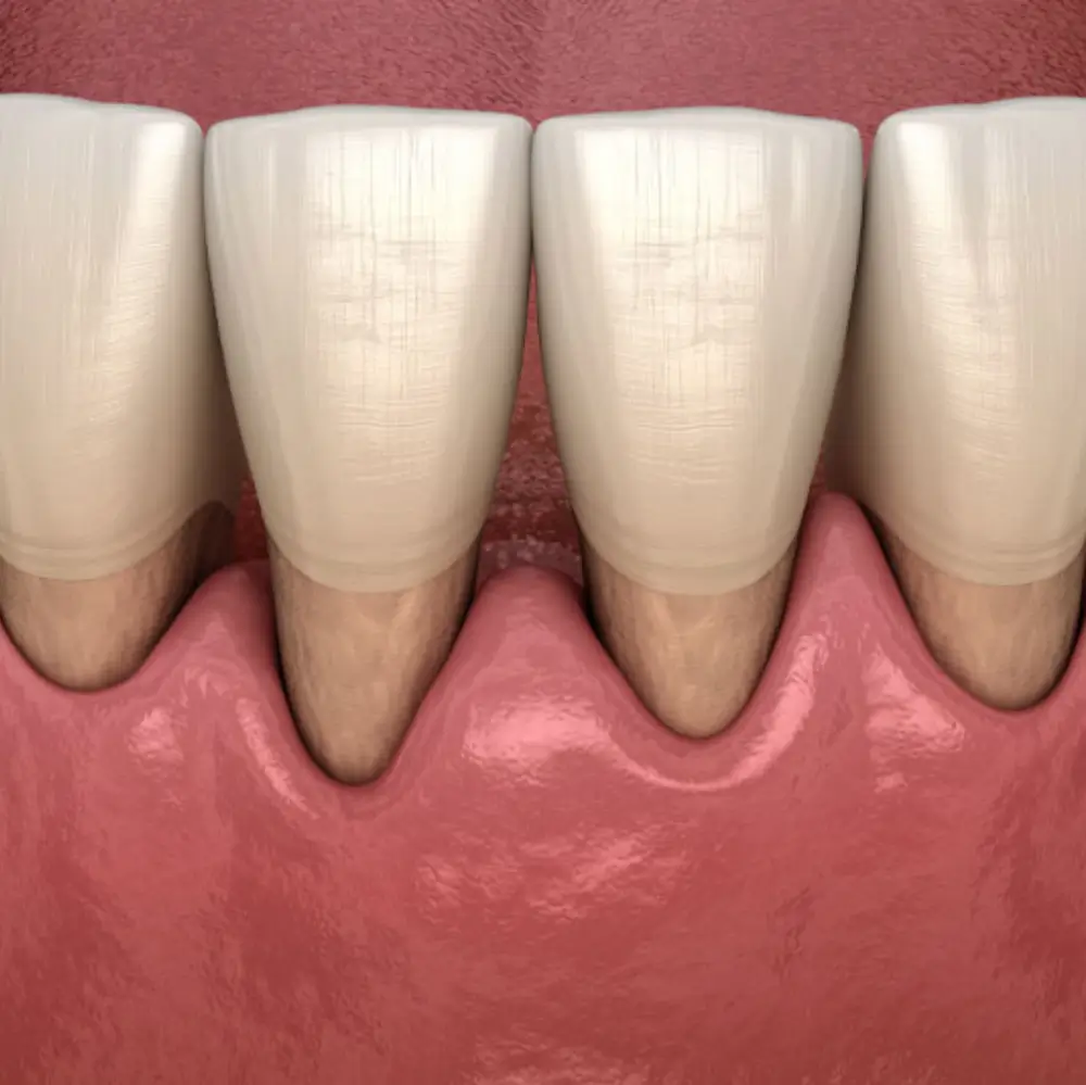 Close up of receding gums before or after a gum grafting treatment.