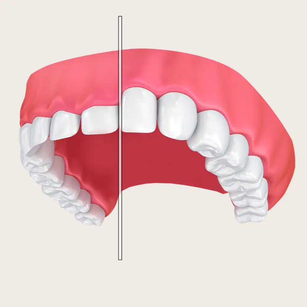 Illustration showing the before and after results of a cosmetic gum lift.