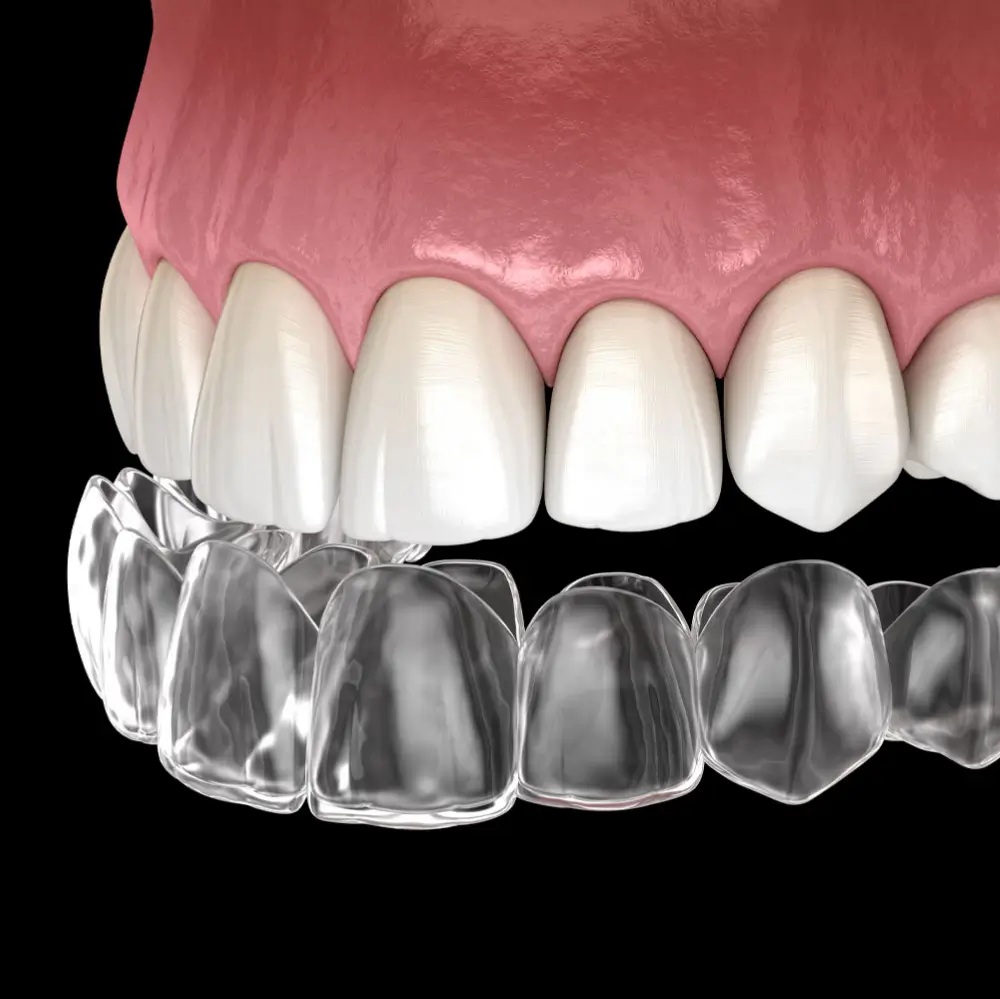 Close up of clear Invisalign aligners being worn on upper and lower teeth.