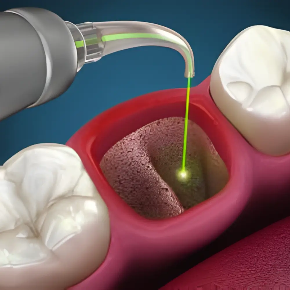 Laser-assisted dental disinfection of the jawbone during a procedure.