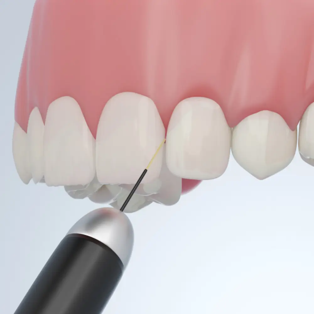 Close up of a dental probe performing an oral biopsy on gum tissue.