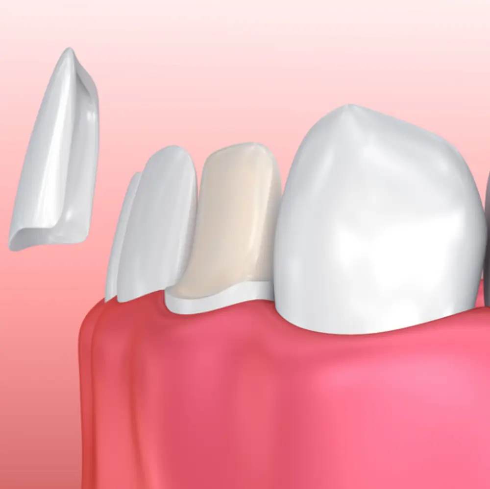 Dental veneers being applied to front teeth for a smile makeover.