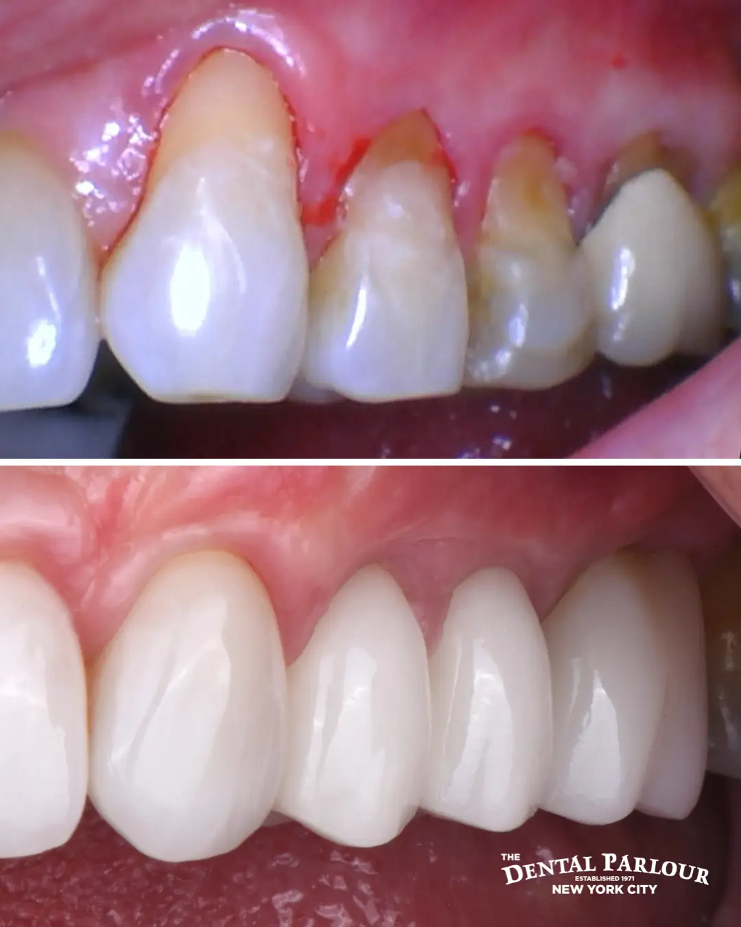gum graft.001