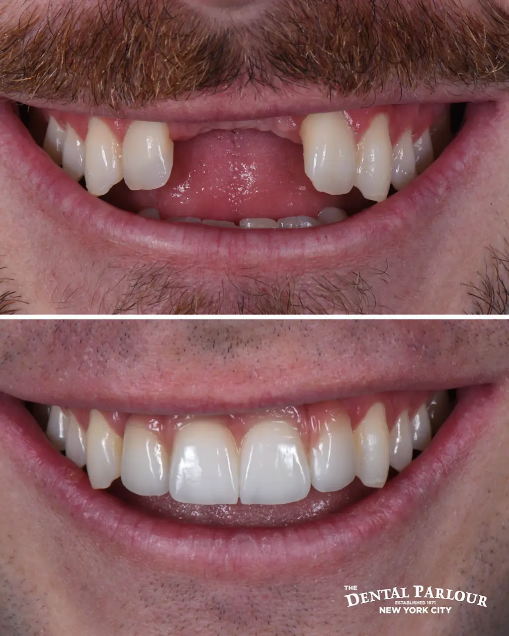 implants3.001