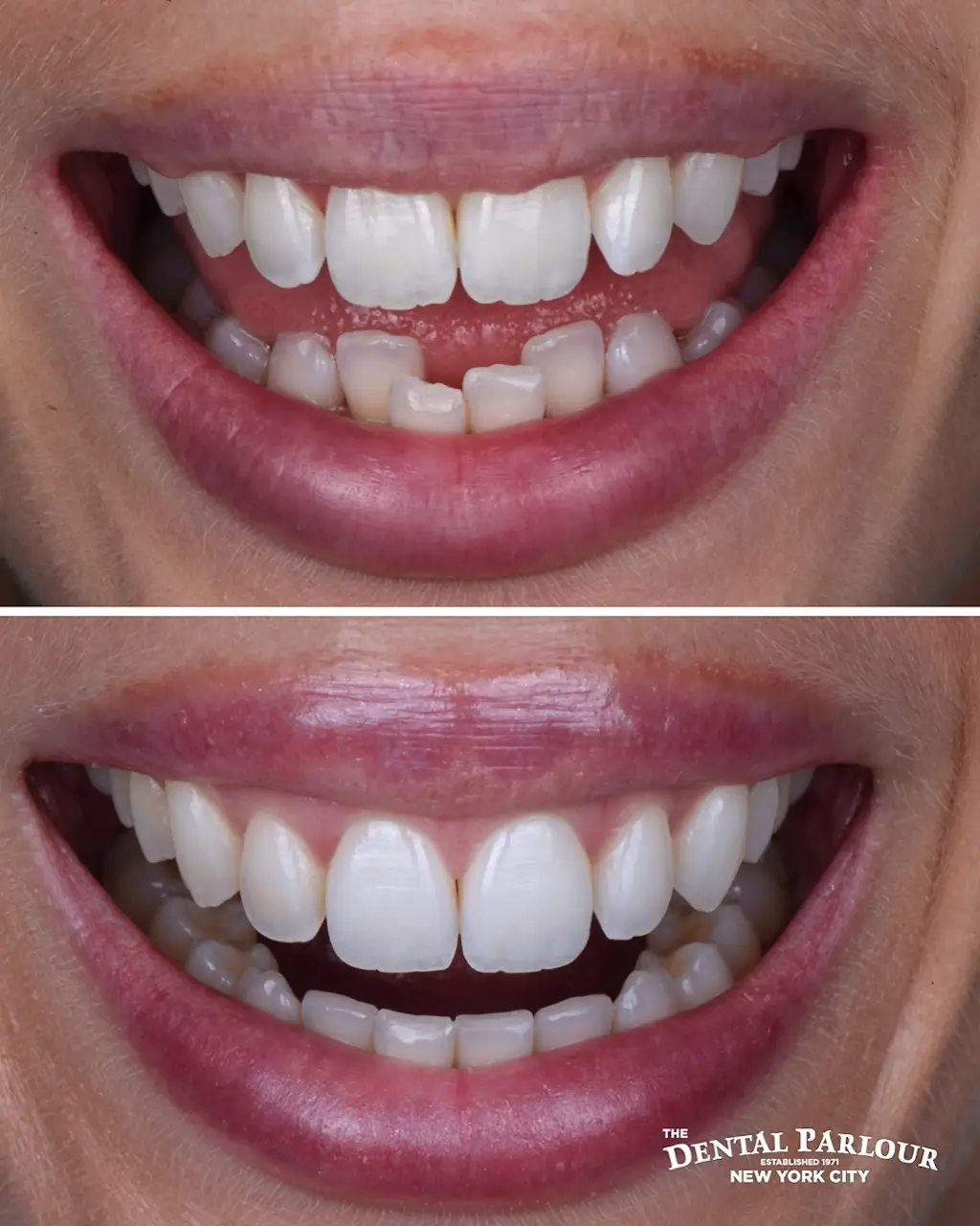 invisalign.001