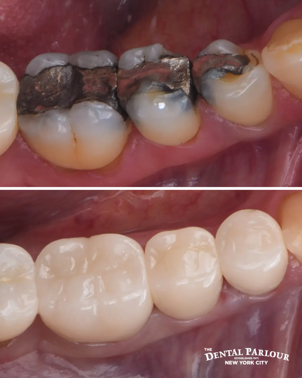 safe amalgam removal png.002