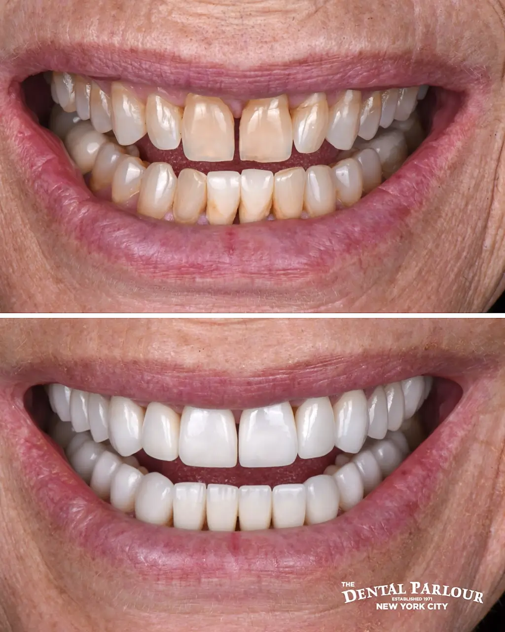 veneers1.001 (1)