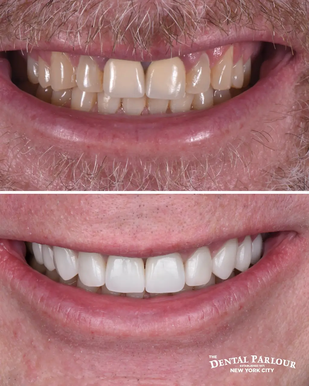 veneers2.001 2 (1)