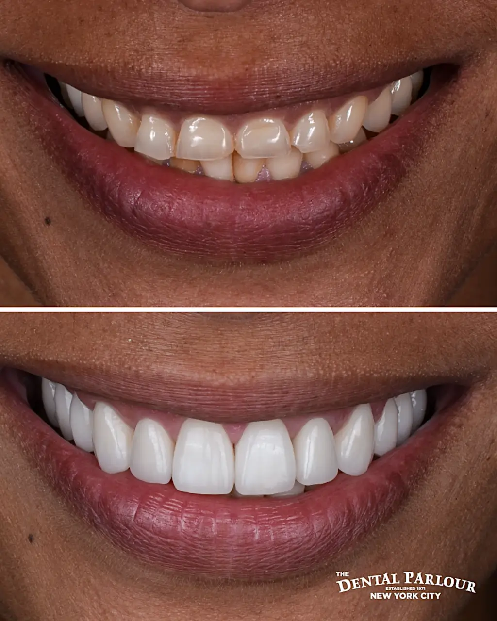 veneers4.001 (1)