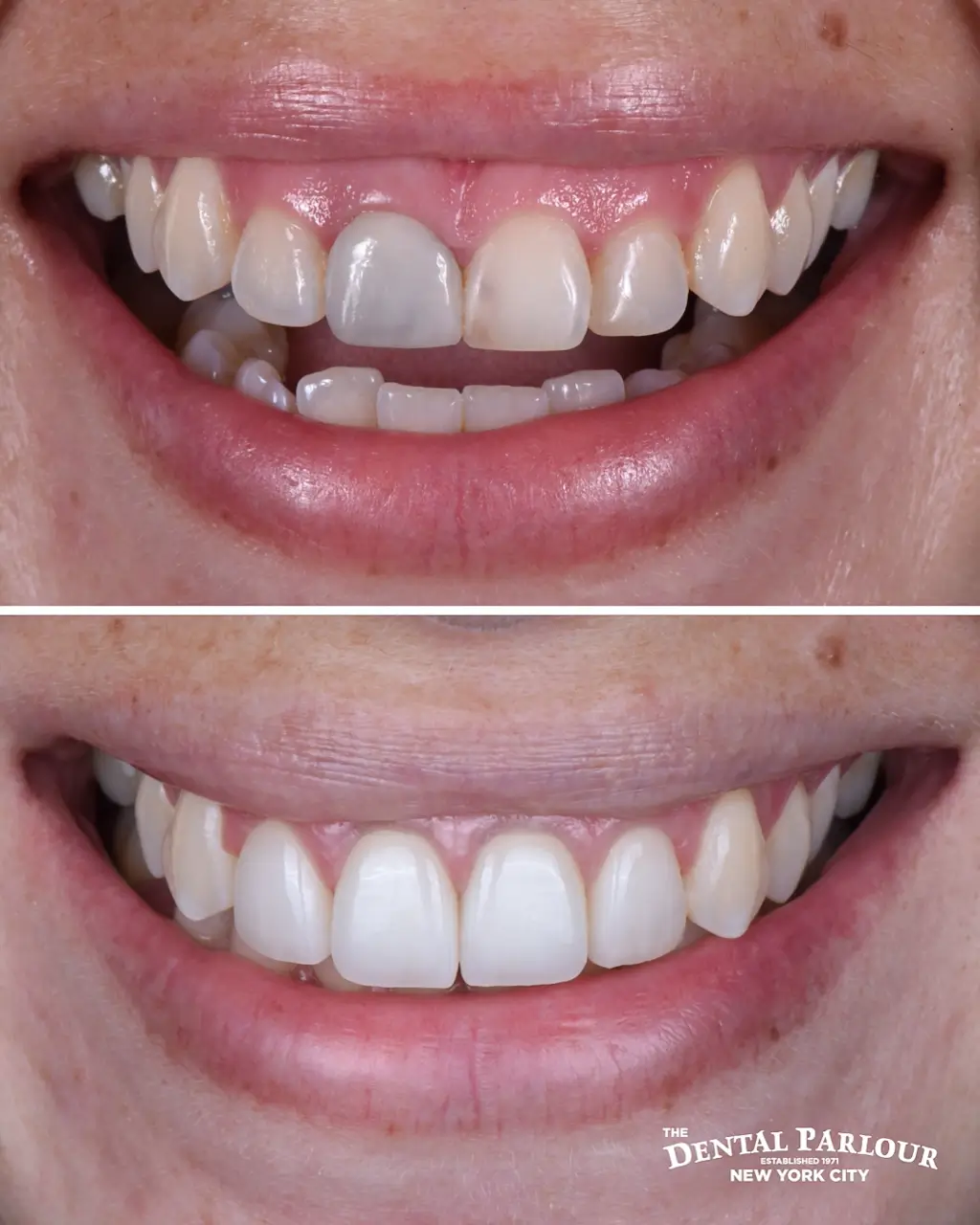 veneers5.001 2 (1)