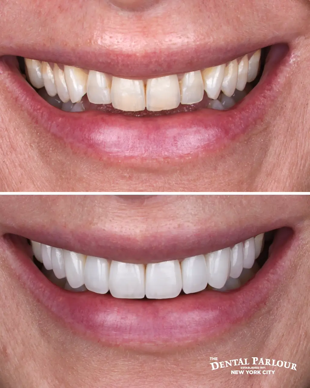 veneers6.001